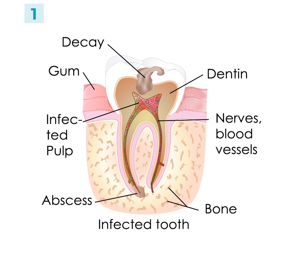 Root Canal - Steps