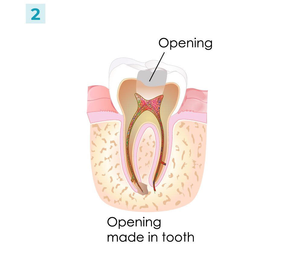 Root Canal - Steps