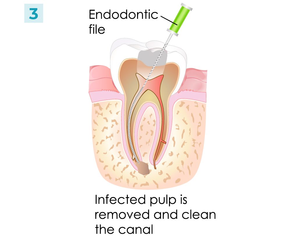 Root Canal - Steps