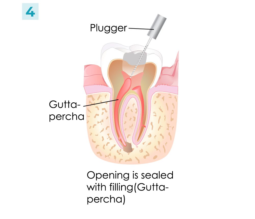 Root Canal - Steps