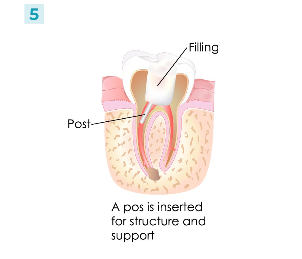 Root Canal - Steps