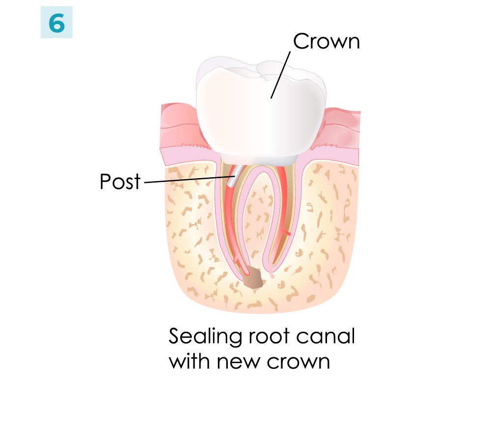 Root Canal - Steps