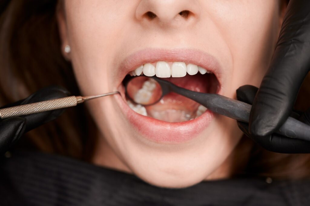 Preventing problems in Root canal